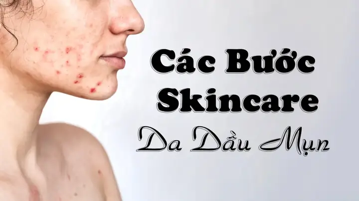 Cac-buoc-skincare-cho-da-dau-mun