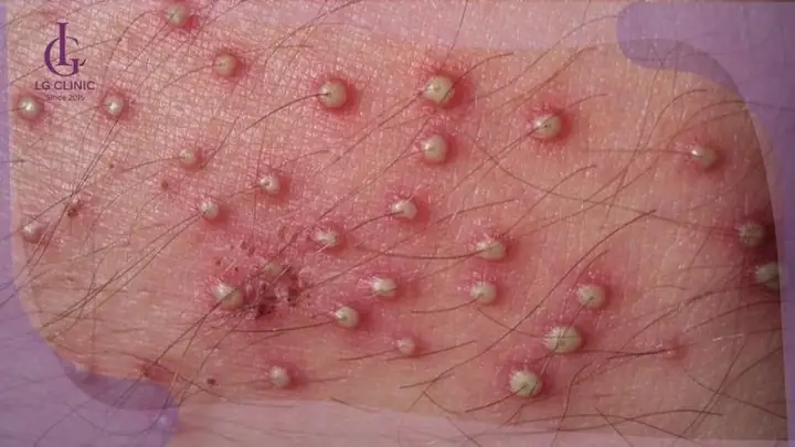 Viêm Nang Lông Và Viêm Lỗ Chân Lông