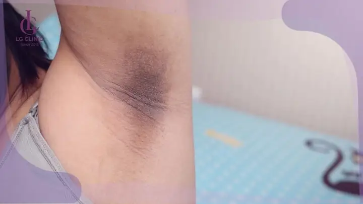 Da Thâm Đen Mất Thẩm Mỹ