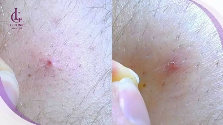 Lông Mọc Ngược