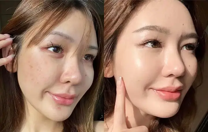 Các Phương Pháp Tiêm Trẻ Hóa Sẽ Giúp Cung Cấp Dưỡng Chất Cho Da Căng Bóng, Mịn Màng Hơn