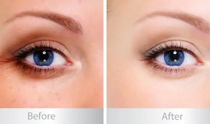 2.2. Giảm quầng thâm, bọng mắt