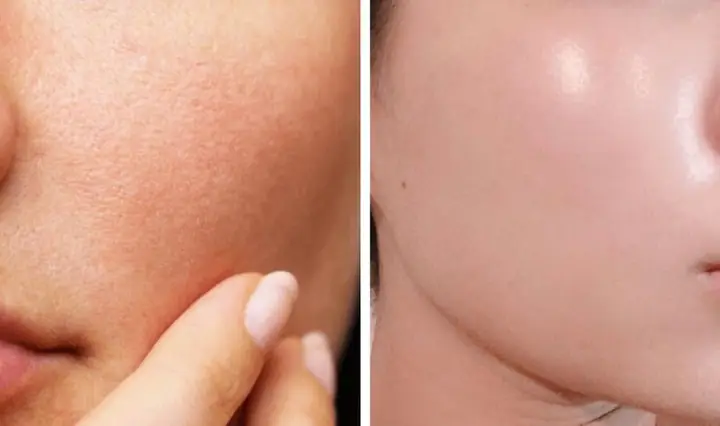 2.1. Se khít lỗ chân lông