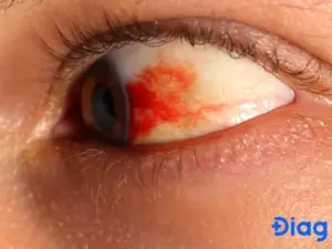 Các Biến Chứng Ở Mắt Các Biến Chứng Ở Mắt