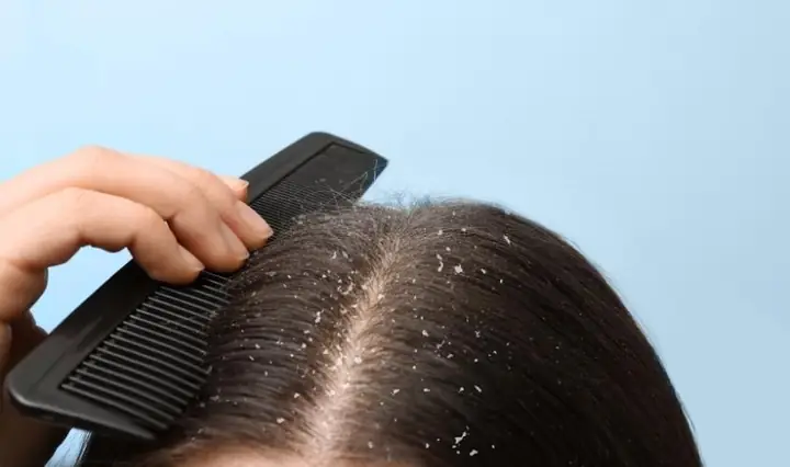 1Nguyên nhân gây ngứa da đầu