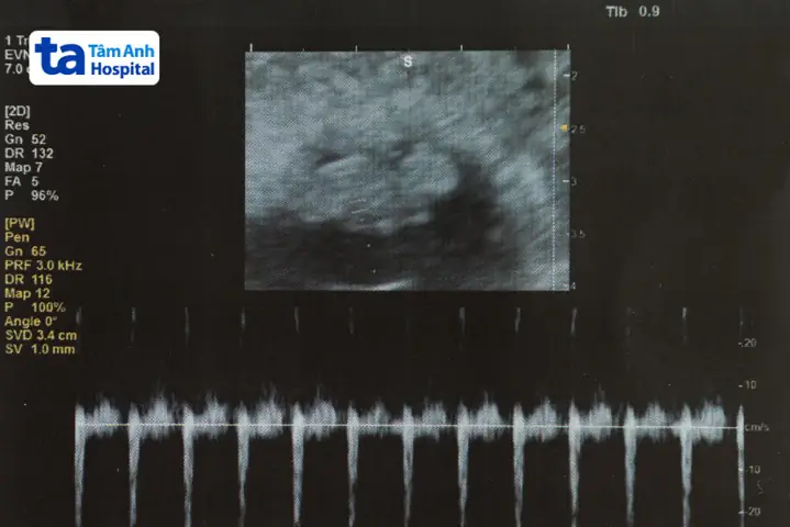 Hình Dạng Và Kích Thước Của Thai 7 Tuần Tuổi