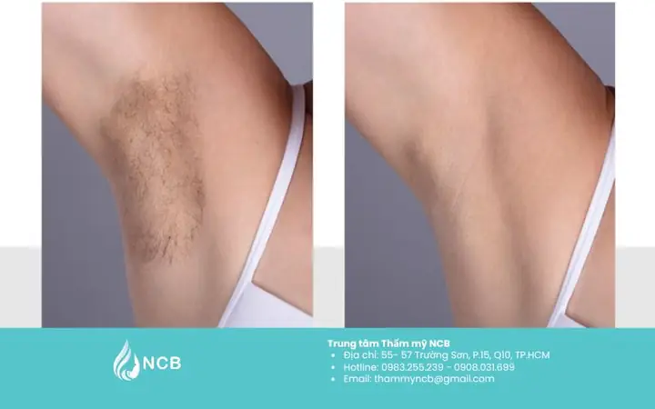 Có Nên Triệt Lông Nách Vĩnh Viễn Không? Có Nên Triệt Lông Nách Vĩnh Viễn Không?