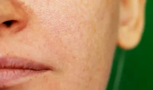 1Nguyên nhân khiến lỗ chân lông to