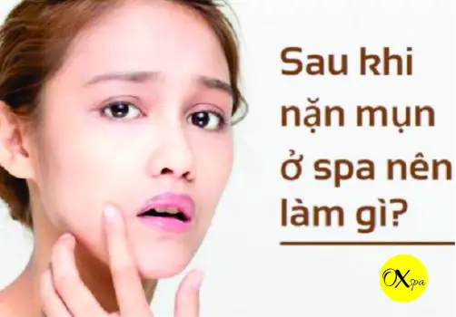 Sau Khi Nặn Mụn Có Nên Bôi Kem Trị Mụn, Oxspa Sau Khi Nặn Mụn Có Nên Bôi Kem Trị Mụn, Oxspa