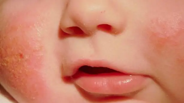 Thuốc Bôi Bepanthen Balm Có Trị Được Chàm Sữa Không? Thuốc Bôi Bepanthen Balm Có Trị Được Chàm Sữa Không?