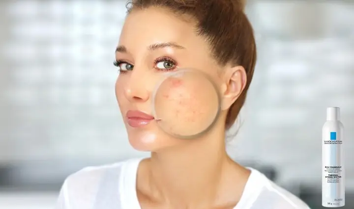 1vì Sao Nên Dùng Xịt Khoáng Cho Da Dầu Mụn? 1vì Sao Nên Dùng Xịt Khoáng Cho Da Dầu Mụn?