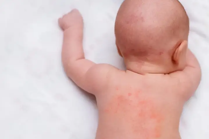 4khi Nào Nên Đưa Trẻ Đi Khám Sau Khi Tiêm Phòng?