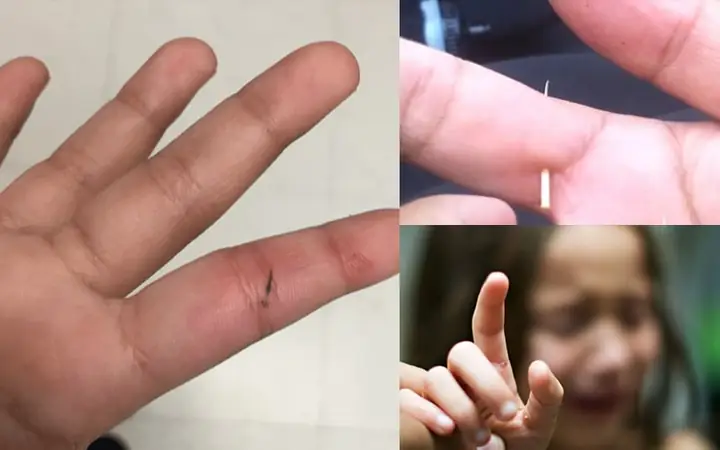 Mách Bạn Mẹo Lấy Dằm Nhanh Chóng, Hiệu Quả Và Không Đau ...