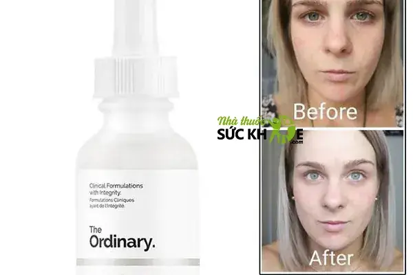 Serum The Ordinary Niacinamide 10% + Zinc 1% Có Trị Mụn Không? Serum The Ordinary Niacinamide 10% + Zinc 1% Có Trị Mụn Không?