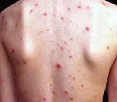 Cách Trị Mụn Lưng Khi Mang Thai Bằng Chanh Cách Trị Mụn Lưng Khi Mang Thai Bằng Chanh