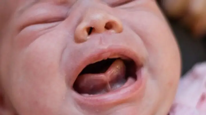 Cắt Thắng Lưỡi Là Gì? Khi Nào Cần Thực Hiện? Cắt Thắng Lưỡi Là Gì? Khi Nào Cần Thực Hiện?