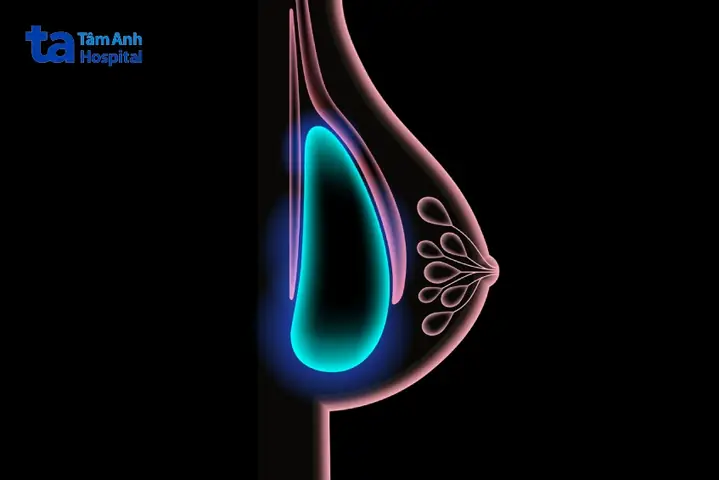 Nâng Ngực Rồi Có Tầm Soát Ung Thư Vú Được Không?