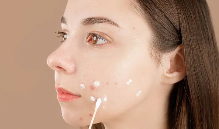 Dùng Nhiều Kem Đánh Răng Có Thể Trị Mụn Hiệu Quả Hơn