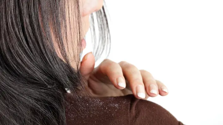 Top 7+ Dầu Gội Trị Gàu Và Rụng Tóc Cực Hiệu Quả