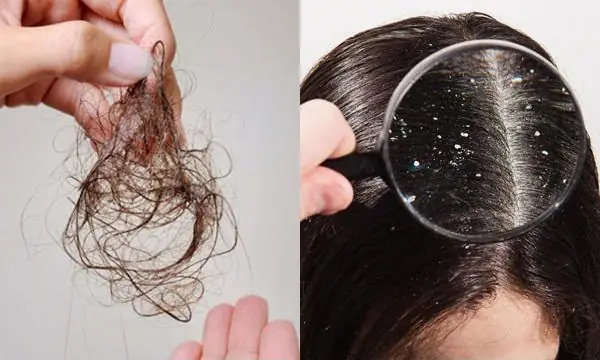 Dầu Gội Trị Gàu Và Rụng Tóc Cho Nữ