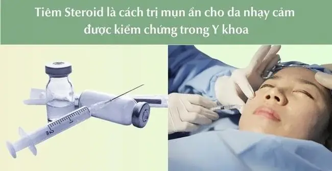 Áp Dụng Tiêm Steroid Trị Mụn Ẩn Cho Da Nhạy Cảm Khi Có Sự Cho Phép Của Bác Sĩ Áp Dụng Tiêm Steroid Trị Mụn Ẩn Cho Da Nhạy Cảm Khi Có Sự Cho Phép Của Bác Sĩ