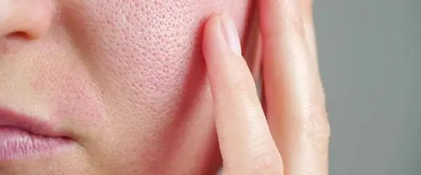 Công Thức Không Gây Bít Tắc (non-comedogenic)