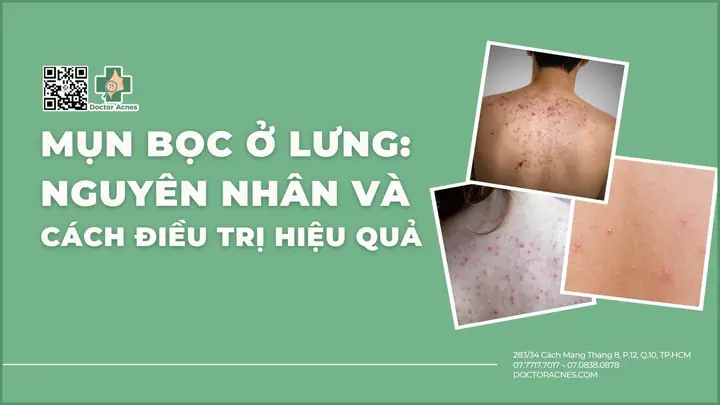 Mụn Bọc Ở Lưng Nguyên Nhân Và Cách Điều Trị Hiệu Quả Mụn Bọc Ở Lưng Nguyên Nhân Và Cách Điều Trị Hiệu Quả