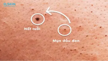 Làm Sạch Mụn Đầu Đen Với Kem Đánh Răng