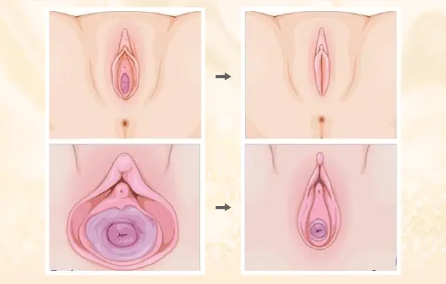 Làm Sao Để Bím Hết Thâm? Hướng Dẫn Xử Lý Vết Thâm Ở Vùng Kín An Toàn Cho Mẹ Sau Sinh Làm Sao Để Bím Hết Thâm? Hướng Dẫn Xử Lý Vết Thâm Ở Vùng Kín An Toàn Cho Mẹ Sau Sinh