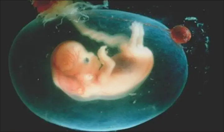 Nước Ối Màu Xanh Đục, Mùi Hôi Nước Ối Màu Xanh Đục, Mùi Hôi