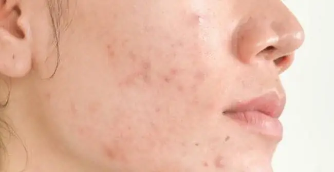 Nguy Cơ Tổn Thương Làn Da Dễ Xảy Ra Sau Khi Nặn Mụn Nguy Cơ Tổn Thương Làn Da Dễ Xảy Ra Sau Khi Nặn Mụn