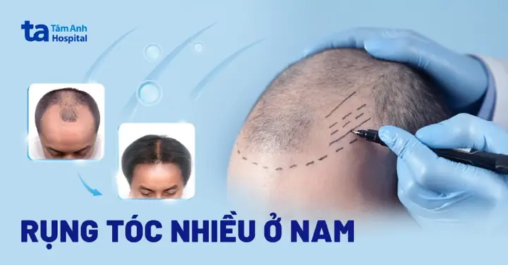 Rụng Tóc Nhiều Ở Nam Giới: Nguyên Nhân, Dấu Hiệu Và Ngăn Ngừa Rụng Tóc Nhiều Ở Nam Giới: Nguyên Nhân, Dấu Hiệu Và Ngăn Ngừa