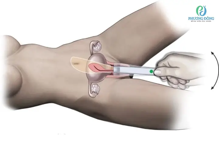 Siêu Âm Đầu Dò Có Thấy Thai Ngoài Tử Cung Không?