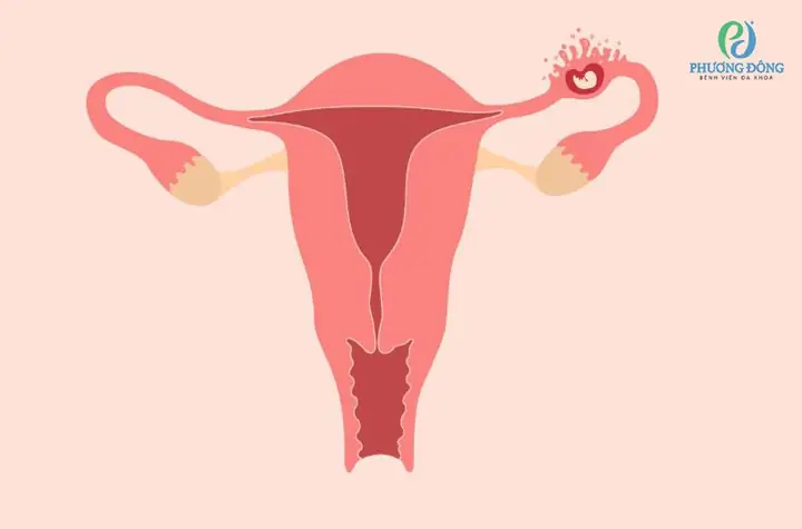 Thai Ngoài Tử Cung Có Tim Thai Không?