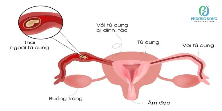 Thai Ngoài Tử Cung Thể Huyết Tụ Thành Nang