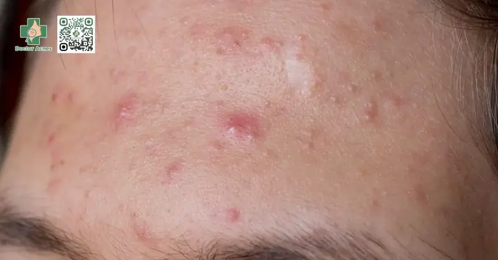 Công Dụng Của Tinh Dầu Tràm Trà Công Dụng Của Tinh Dầu Tràm Trà