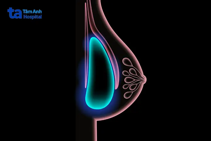 Nâng Ngực Rồi Có Tầm Soát Ung Thư Vú Được Không?