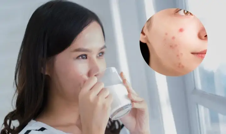 Sữa Lúa Mạch Kun Có Gây Nổi Mụn Không?