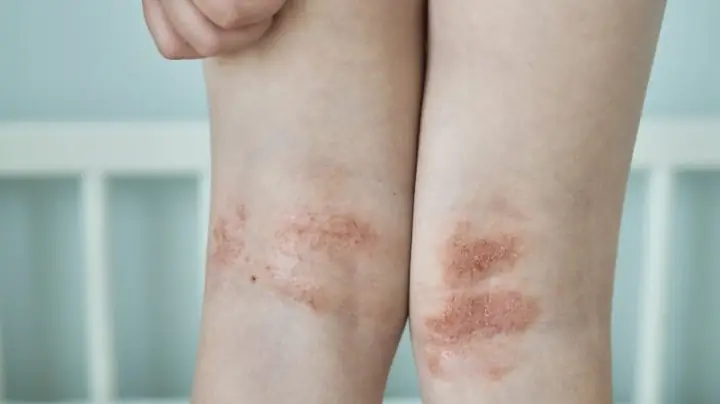 Top 10 Các Loại Thuốc Bôi Viêm Da Cơ Địa Phổ Biến Hiện Nay