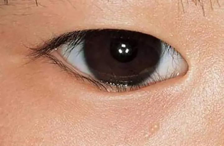 Trẻ Bị Xước Giác Mạc Có Nguy Hiểm Không? Trẻ Bị Xước Giác Mạc Có Nguy Hiểm Không?