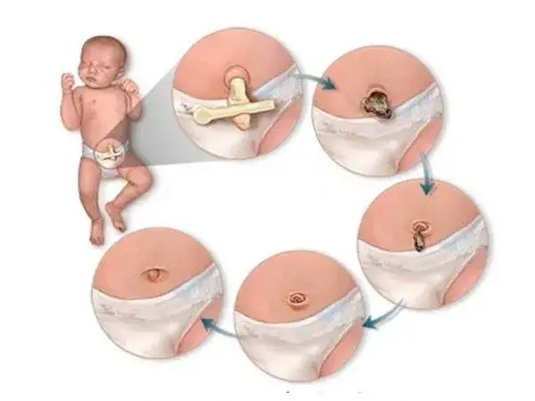 Sau Sinh Rốn Trẻ Sơ Sinh Bao Lâu Thì Rụng ?
