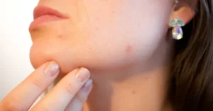 Bệnh Viện Da Liễu Trung Ương Hà Nội Ở Đâu