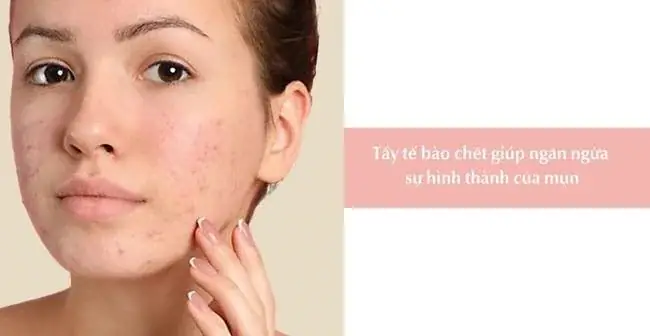 Ngăn Ngừa Tình Trạng Mụn Ngăn Ngừa Tình Trạng Mụn
