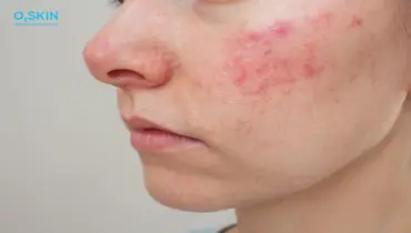 Cách Tẩy Tế Bào Chết Mặt