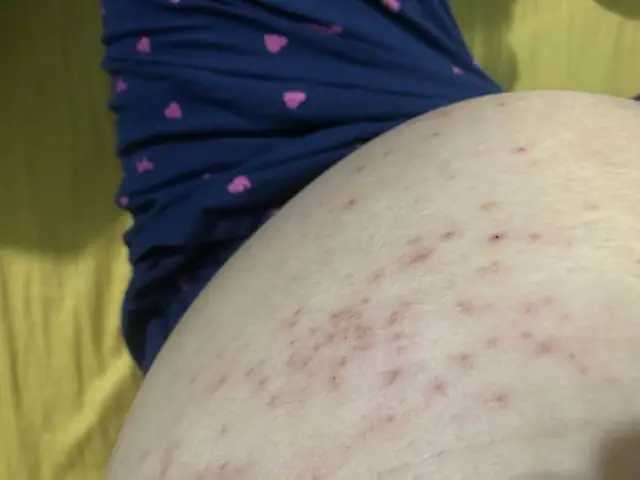 Nguyên Nhân Gây Mụn Ở Bà Bầu Nguyên Nhân Gây Mụn Ở Bà Bầu