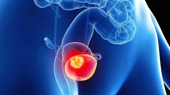 8tăng Nguy Cơ Ung Thư Bàng Quang