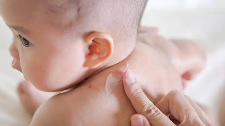 Loại Thuốc Bôi Ngoài Da Trị Ngứa Cho Trẻ Em An Toàn Và Hiệu Quả ... Loại Thuốc Bôi Ngoài Da Trị Ngứa Cho Trẻ Em An Toàn Và Hiệu Quả ...